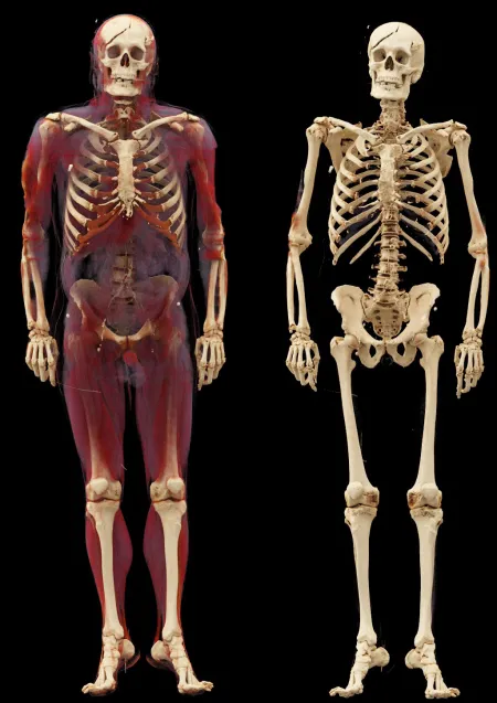 Body scanning: 3D Valeur ajoutée dans  les enquêtes d’homicide